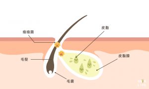 荷爾蒙一旦失調，就會開始分泌皮脂
