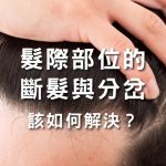 髮際部位的斷髮與分岔竟是禿頭前兆？該如何解決？