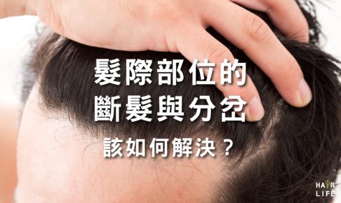 髮際部位的斷髮與分岔竟是禿頭前兆？該如何解決？