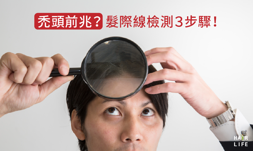 【禿頭前兆】髮際線後移了嗎？３個步驟教你判別！