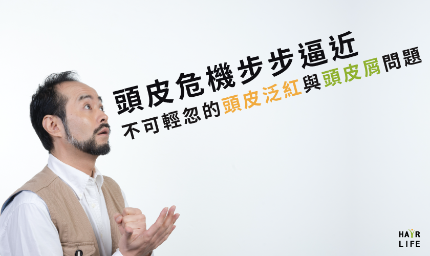 頭皮危機步步逼近中!你不可輕忽的頭皮泛紅與頭皮屑問題