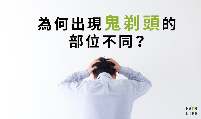 【禿頭五四三】為何每個人出現鬼剃頭的部位不同？