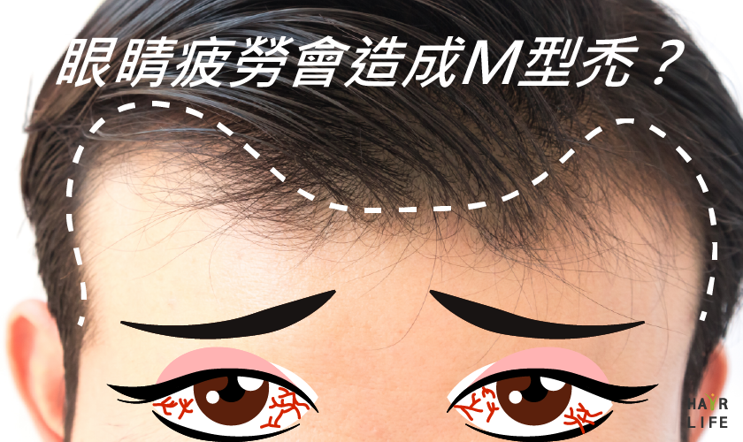 眼睛疲勞會導致M型禿？解析髮際線禿頭和眼睛的關聯性