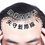 Ｍ型禿頭年輕化！？如何挽救失守髮際線？