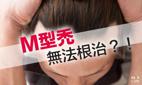 M型禿頭無法根治嗎？！真相大解析！
