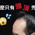 為什麼只有頭頂禿頭？禿頭原因出在荷爾蒙！？